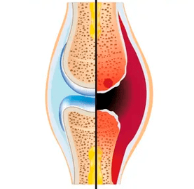 Budowa zdrowego i zużytego stawu z oznaczeniem tkanki chrzęstnej i mazi stawowej