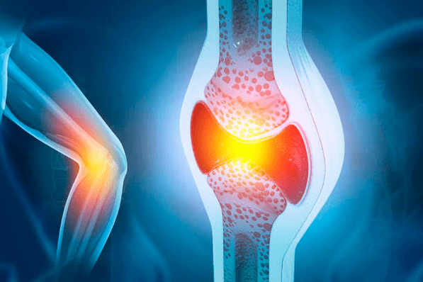 Zapobieganie chorobom stawów